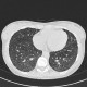 H1N1, atypical pneumonia, follow-up: CT - Computed tomography